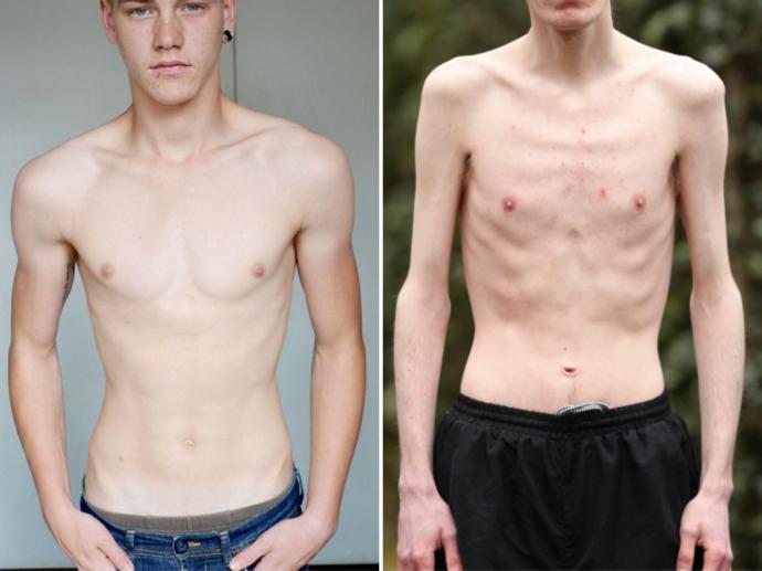 Girls: Would you date a guy who is underweight?