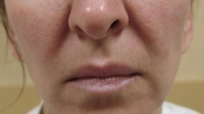 Strong nasolabial folds, help?