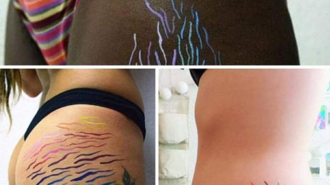 Would you get your stretch marks colored in?