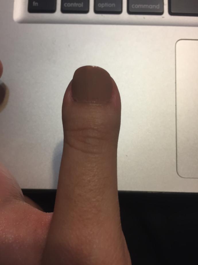 Would it bother you if your SO had a clubbed thumb? 