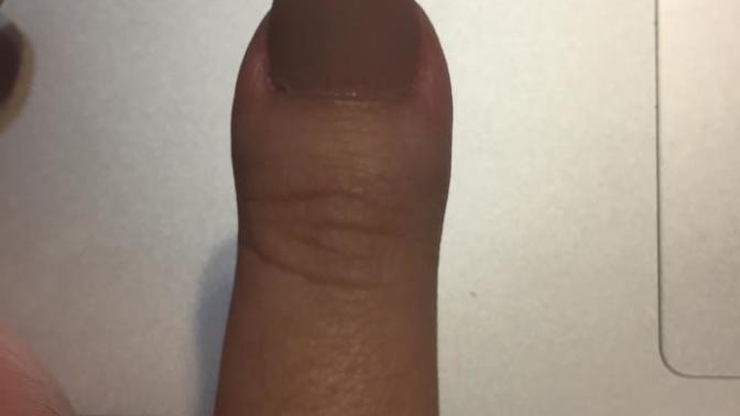 Would it bother you if your SO had a clubbed thumb?