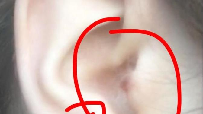 Can I remove this mole with dental floss?