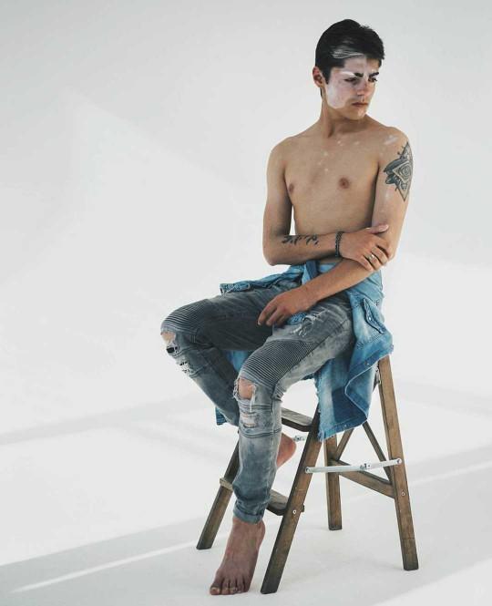 How do you feel about people with vitiligo skin??