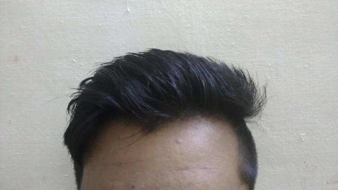Does my forehead look like receding hairline? Also do women hate men with receding hairline?