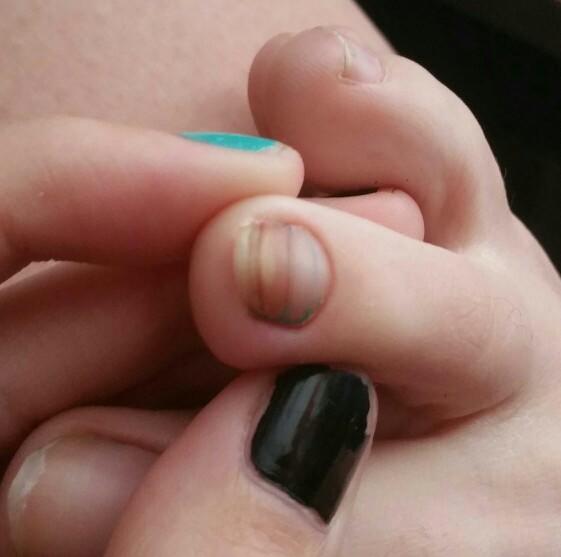 My toenail is weird, is it normal??