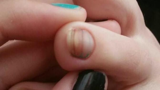 My toenail is weird, is it normal?
