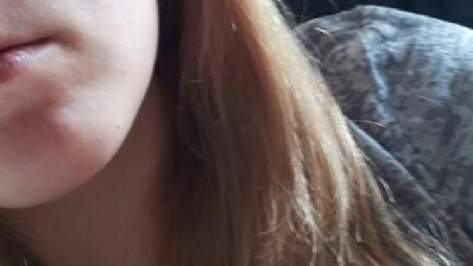 How To Once And For All Stop Getting Acne Scars?