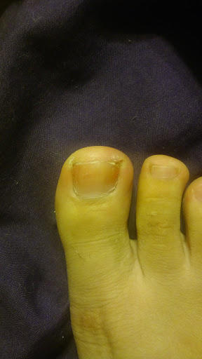 What is this bump on my big toe?