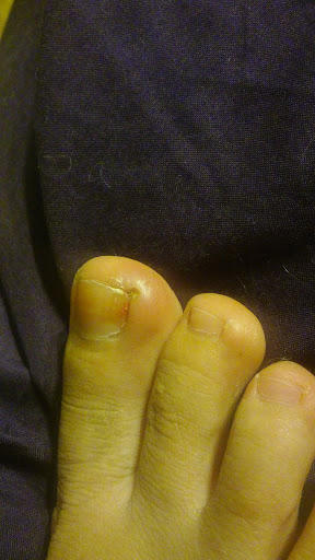 What is this bump on my big toe?