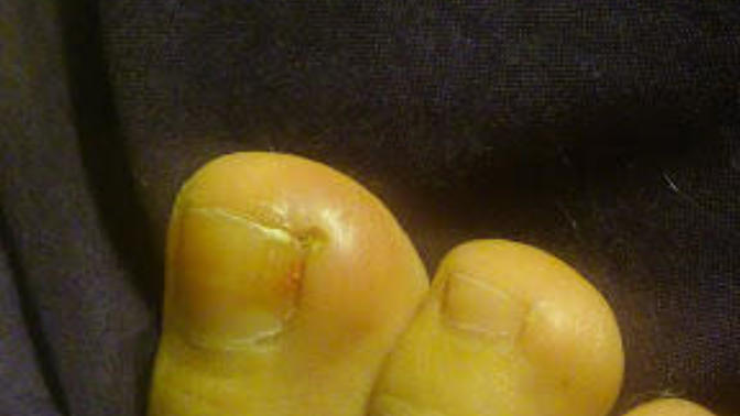 What is this bump on my big toe?