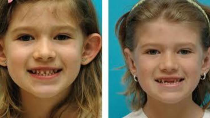 Would you alter your child's appearance cosmetically for them to fit in?