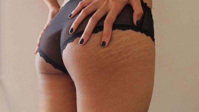 Do guys notice stretch marks?