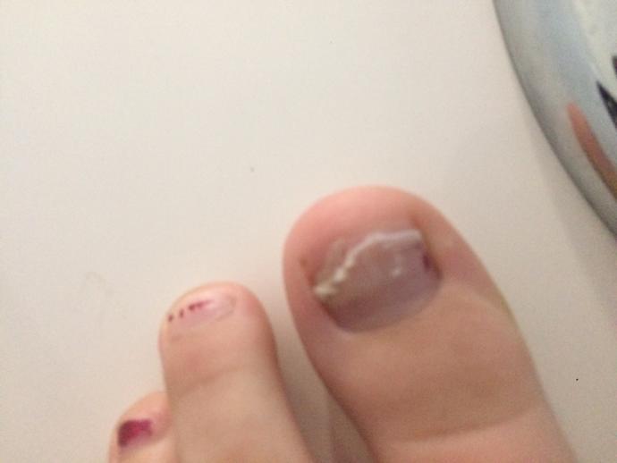 I cut my toenail halfway down will it grow back?