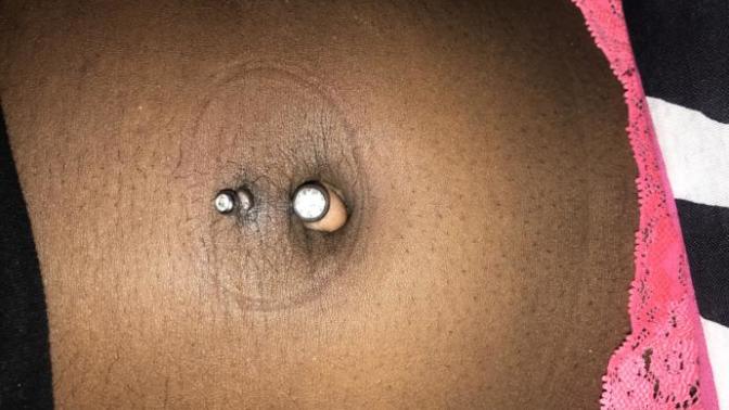 Should I take this piercing out? Is it infected or is this just a bump?