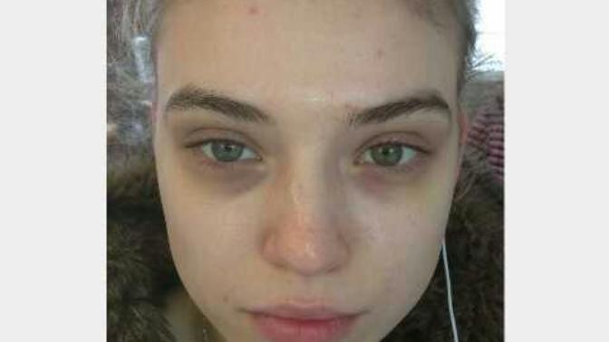 Are dark circles a turn off on girls?