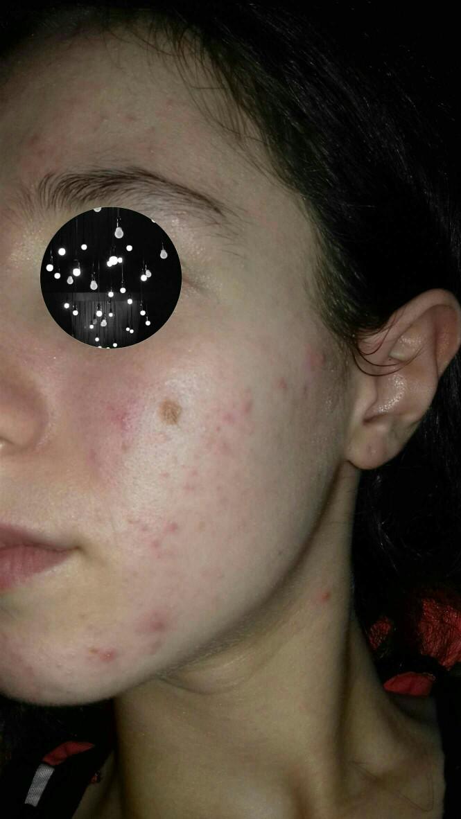 Suffering from really bad acne??