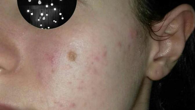 Suffering from really bad acne?