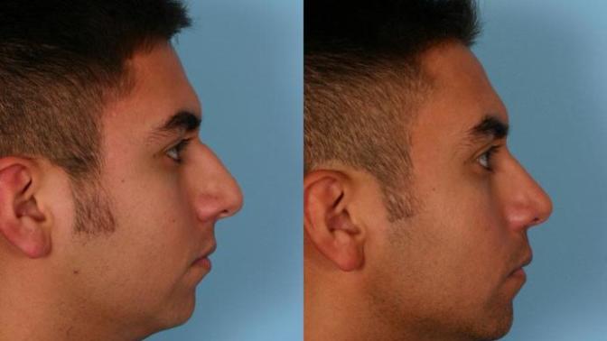 Girls, would you date a guy who has undergone rhinoplasty (a nose job)?