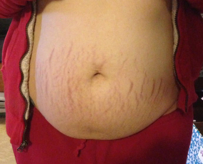 Are stretch marks on pregnant bellies a turn off? (Pics included)?
