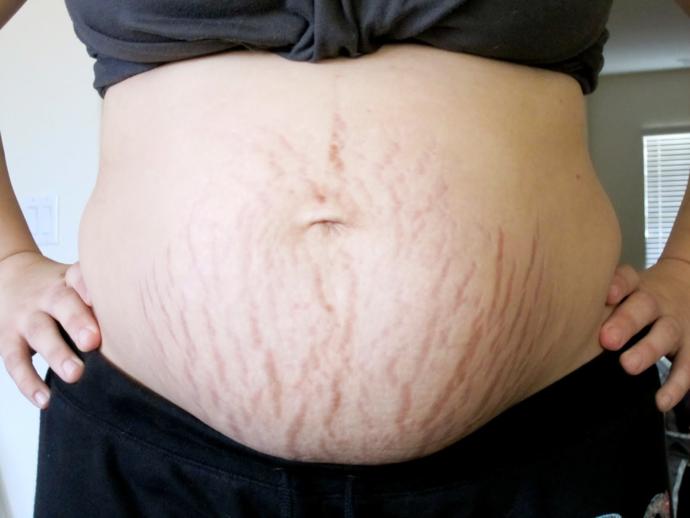 Are stretch marks on pregnant bellies a turn off? (Pics included)?