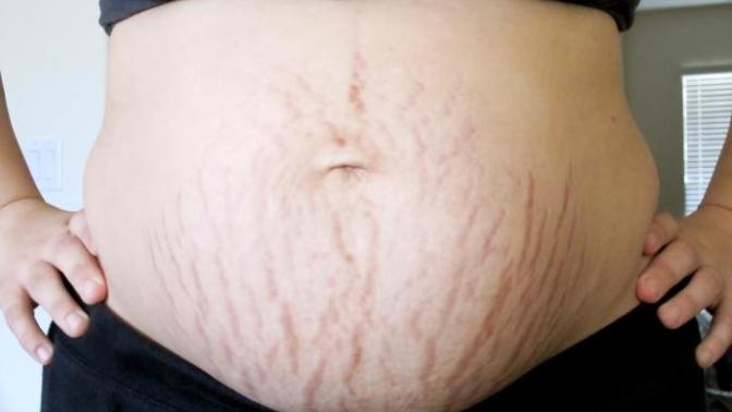 Are stretch marks on pregnant bellies a turn off? (Pics included)?