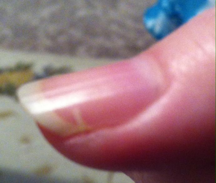 What can I do about my nails?