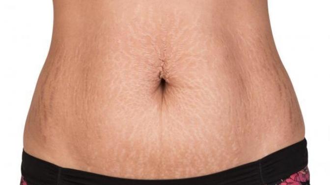 Guys, do you think stretch marks a turn off?