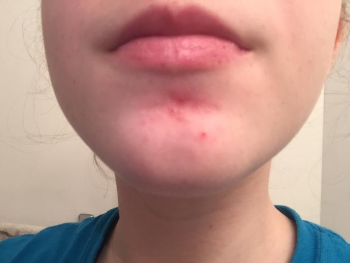 What is this acne on my chin? I can’t go to a doctor and it keeps coming back. (This is it now cuz I picked at it). What can I do?