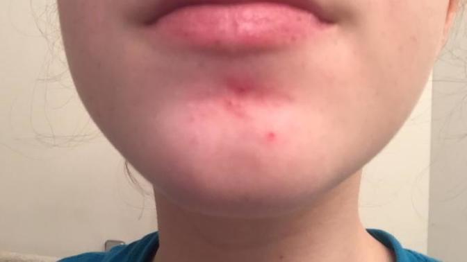 What is this acne on my chin? I can’t go to a doctor and it keeps coming back. (This is it now cuz I picked at it). What can I do?