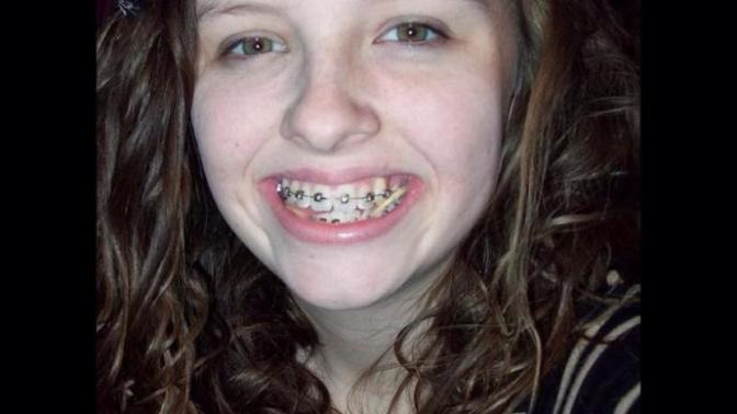 Girls, Do I look awkward when I smile showing my braces?