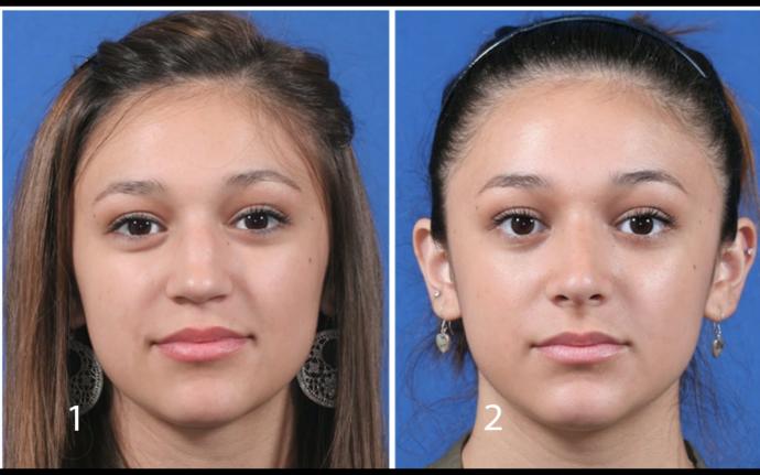 Rhinoplasty yes or no ?