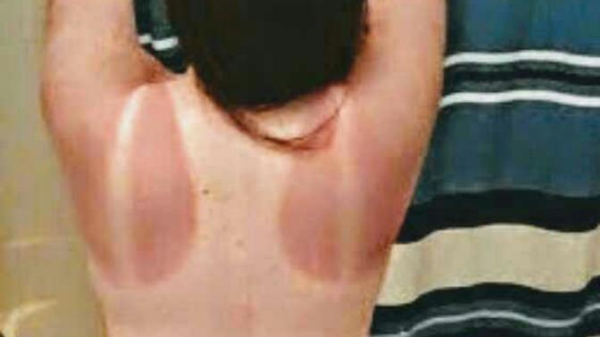 What Do You Think Of This Sunburn?