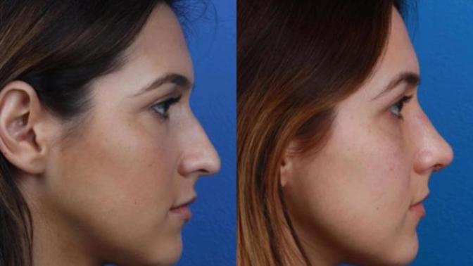 Is rhinoplasty surgery (nose job procedure) painful?