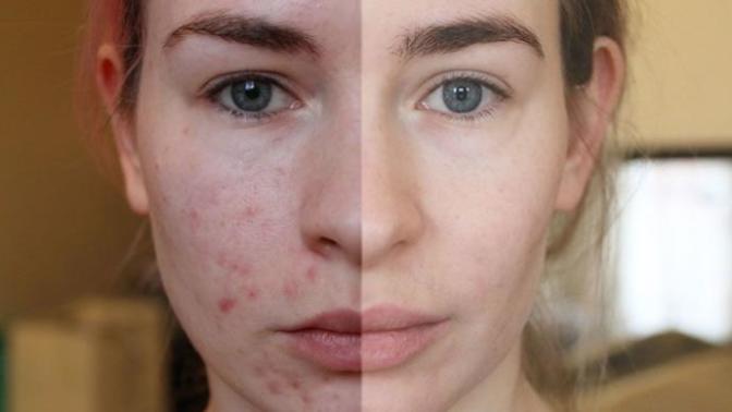 Guys, Does it matter to you if a good looking girl has acne and acne scars?