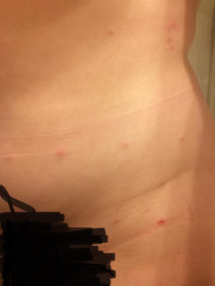 What could these red bumps on my torso and breast be? Has anyone experienced something similar?
