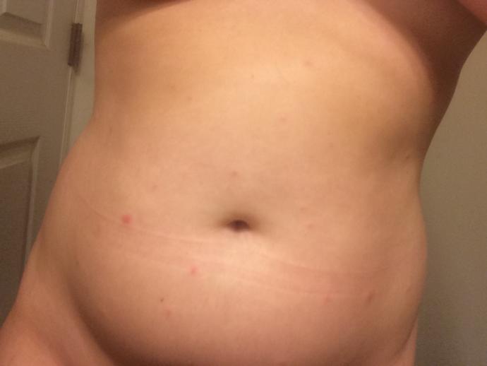 What could these red bumps on my torso and breast be? Has anyone experienced something similar?