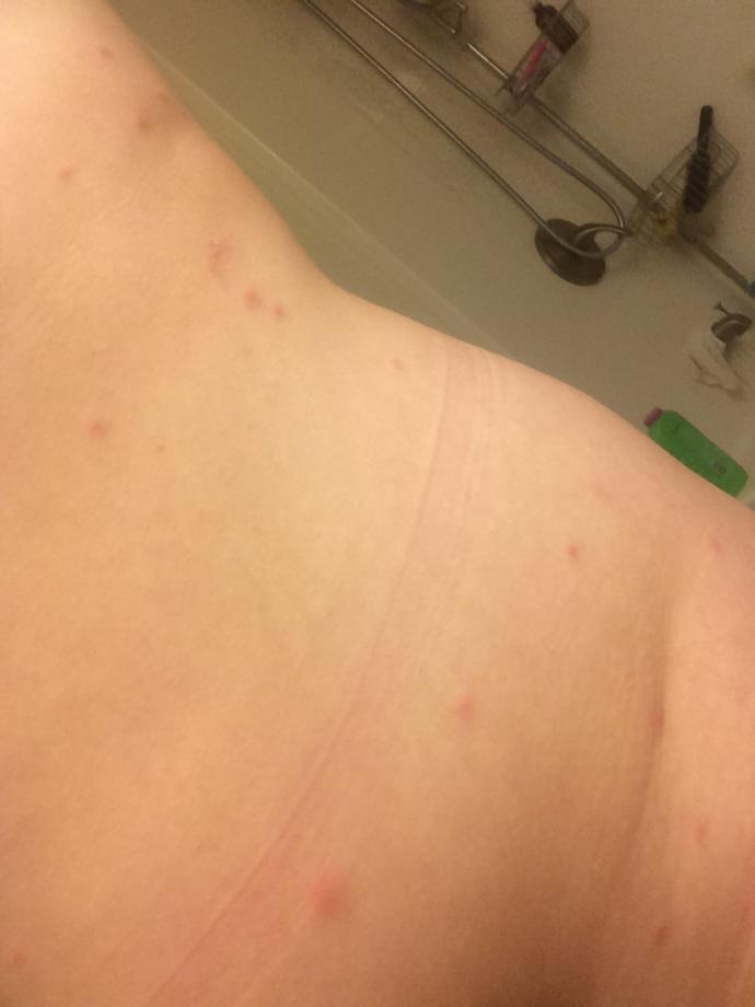 What could these red bumps on my torso and breast be? Has anyone experienced something similar?