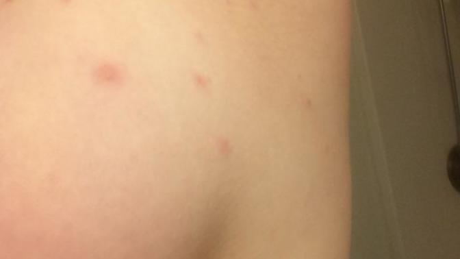 What could these red bumps on my torso and breast be? Has anyone experienced something similar?
