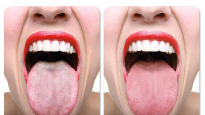Do you brush your tongue?