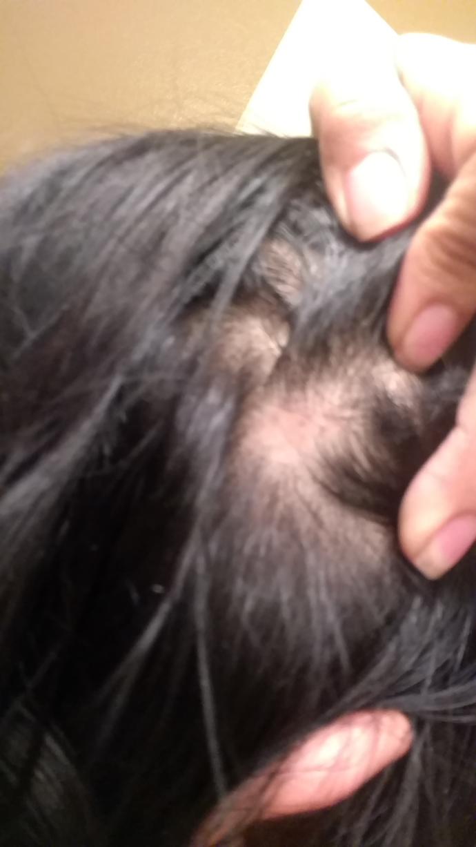 Couple little lumps on scalp? Lost a bit of hair too?
