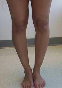 What Do You Guys Think About Bowed Legs?