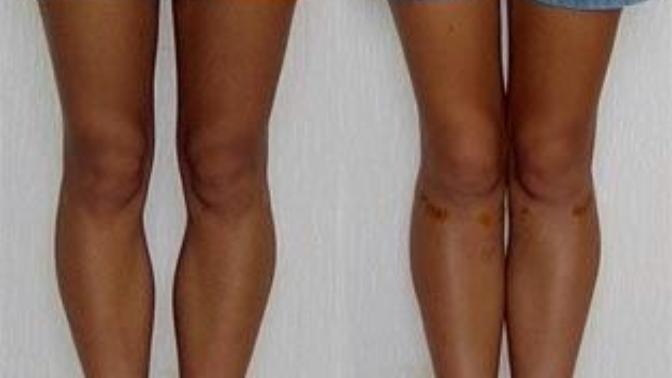 What Do You Guys Think About Bowed Legs?