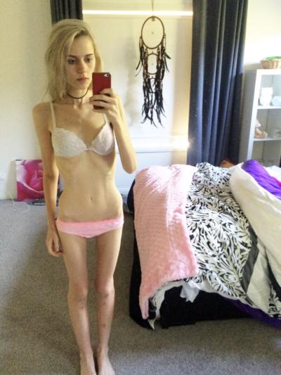 Apologise, Anorexic skinny girls update sorry, that Are Anorexic skinny girls update senseless
