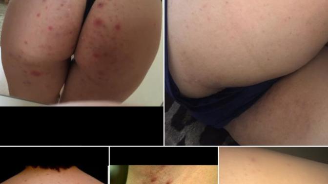 Estimated price & details on a fraxel laser and body acne.. HELP. An educated answer is preferred?
