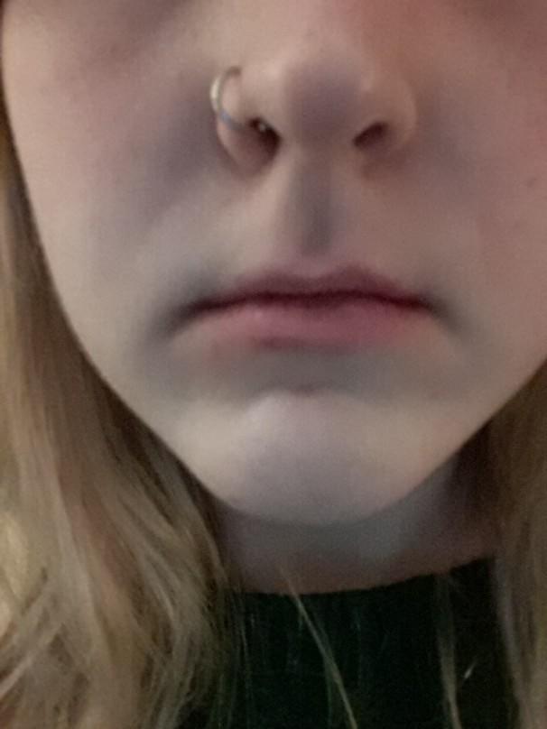 Opinions on lip fillers?