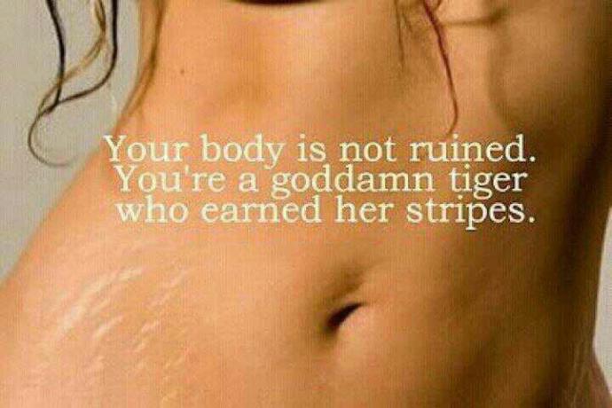 Stretch marks: sexy? ugly? What do you think about them??