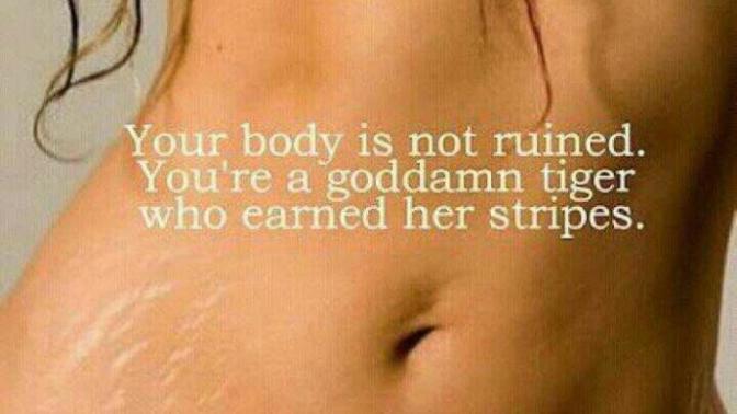 Stretch marks: sexy? ugly? What do you think about them?