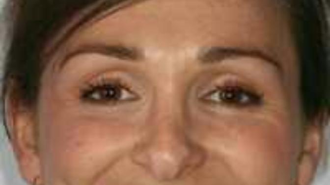 Are Crooked Teeth Ugly?