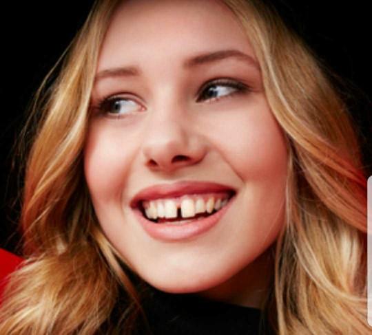 Whats wrong with gapped teeth ??