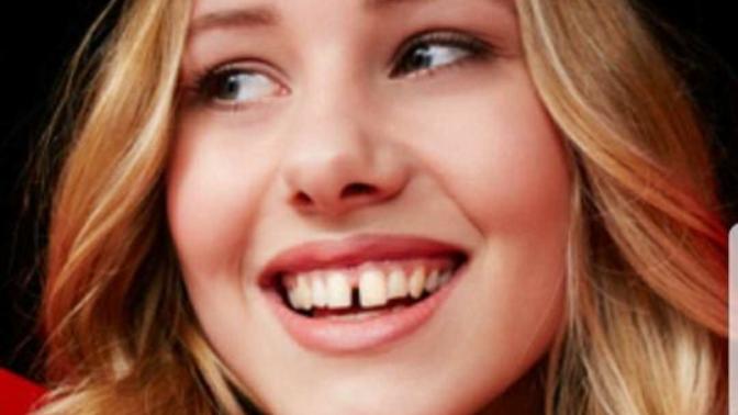 Whats wrong with gapped teeth?